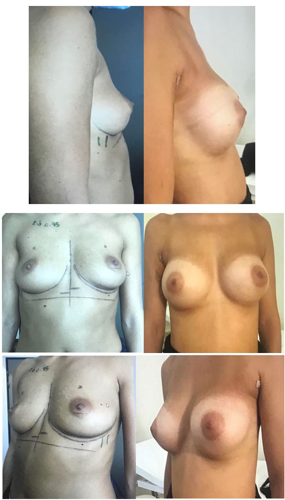 Remplissage du creux supérieur des seins par implants anatomiques par voie axillaire sans cicatrice - résultats à 6 jours (septembre 2020)