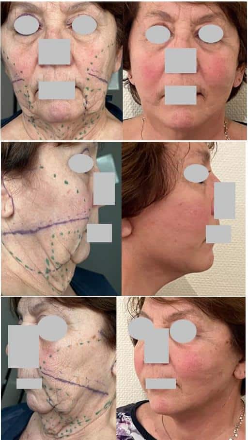 Face-lift musculaire exérèse boules de bichât