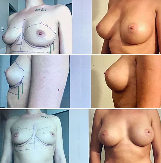 Implants mammaires 335cc - Prothèses anatomiques retro musculaires voie axillaire