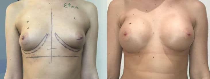 Implants mammaires anatomiques rétromusculaire  310cc x2 -Augmentation de volume mammaire modérée
