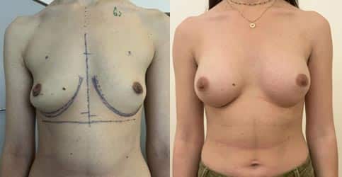 Implants mammaires anatomiques sans cicatrice (juin 2023)