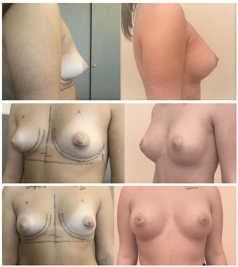Implants mammaires retro musculaire sans cicatrice (mars 2022)