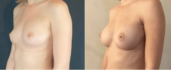 Implants mammaires retro musculaires anatomiques pour une forme naturelle