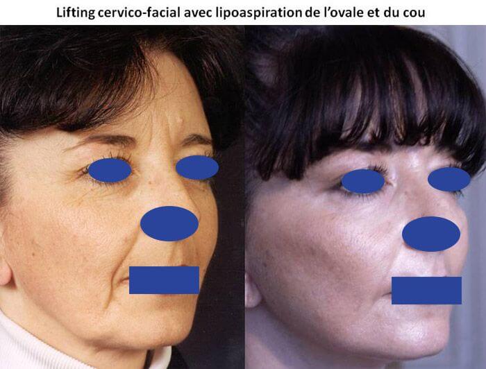 Lifting cervico-facial avec lipoaspiration de l'ovale et du cou