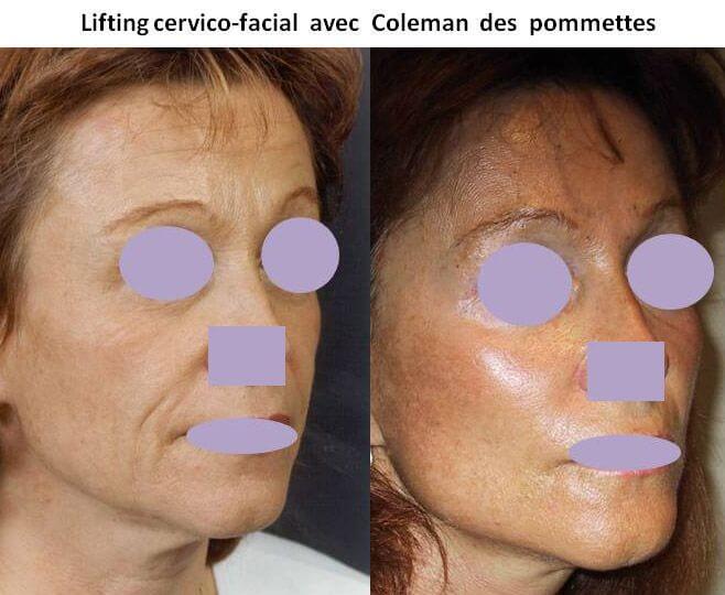 Lifting cervico-facial avec Coleman des pommettes