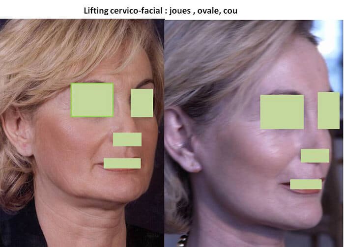Lifting cervico facial: joues, ovale et cou