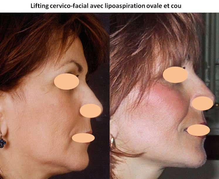Lifting cervico-facial avec lipoaspiration ovale, cou