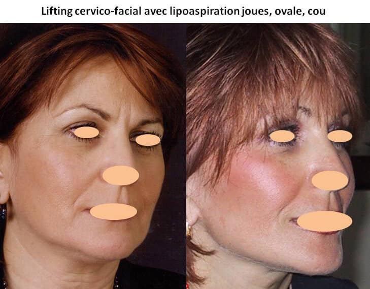 Lifting cervico-facial avec lipoaspiration joues, ovale, cou