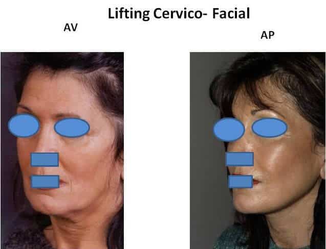 Lifting cervico-facial