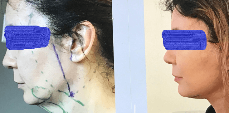 Lifting cervico-facial