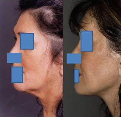Lifting cervico-facial