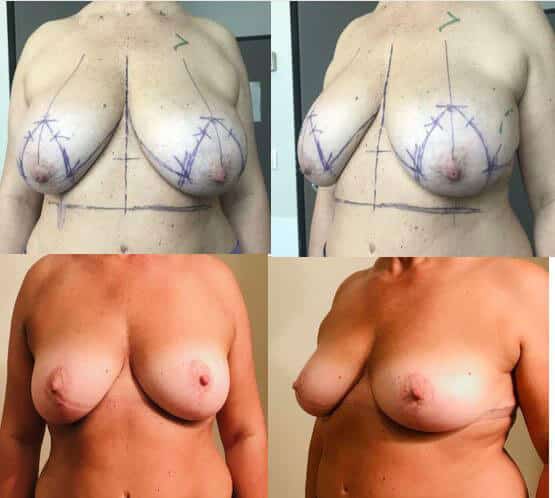 Lifting des seins avec réduction de volume (septembre 2021)