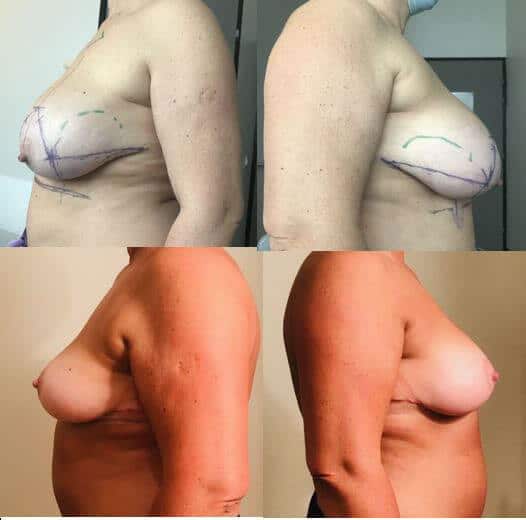 Lifting des seins avec réduction de volume (septembre 2021)
