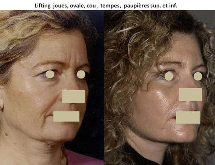 Lifting des joues, ovale, cou, tempes, paupières inférieures et supérieures