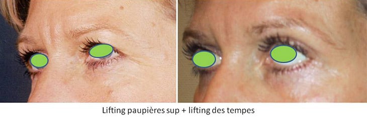 Lifting des paupières supérieures et lifting des tempes