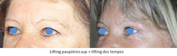 Lifting des paupières supérieures & Lifting des tempes