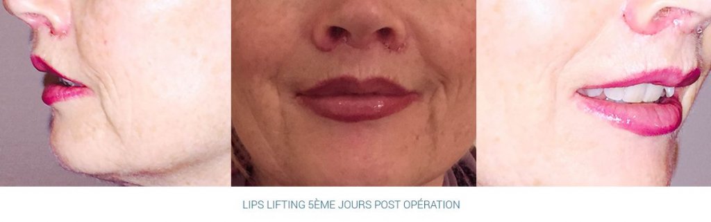 Lips lifting - 5 jours après l'opération
