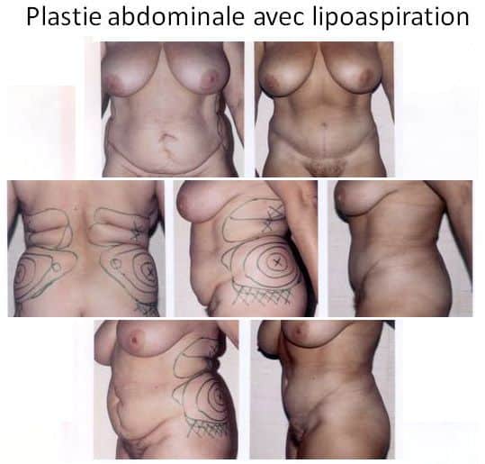Plastie abdominale avec lipoaspiration