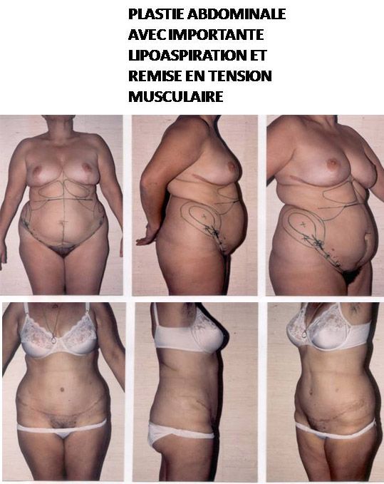 Plastie abdominale avec remise en tension musculaire et réfection d'une cicatrice verticale préexistante