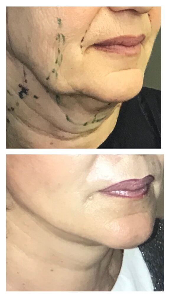Restauration de la ligne de l ovale par exérèse des boules de bichât descendues dans les bajoues et face lift cervico facial-