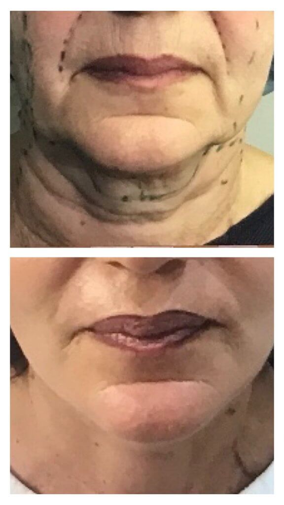 Restauration de la ligne de l'ovale par exérèse des boules de Bichat descendues dans les bajoues et face lift cervico facial