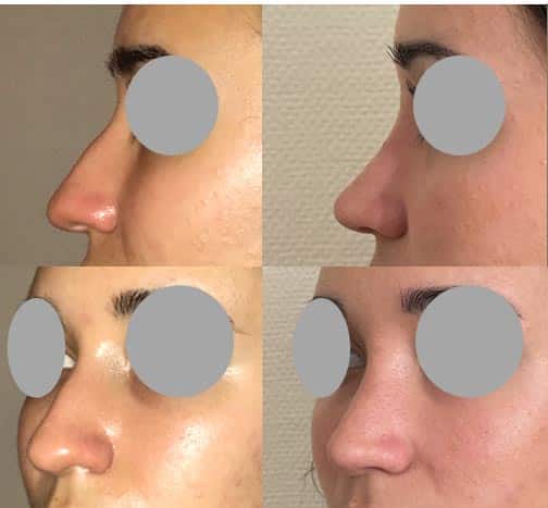 Rhinoplastie (avril 2022)