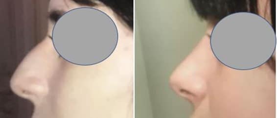 Rhinoplastie - Suppression de la bosse et allégement de la pointe du nez (janvier 2021)