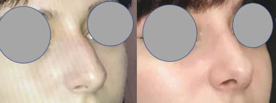 Rhinoplastie - Suppression de la bosse et allégement de la pointe du nez (janvier 2021)
