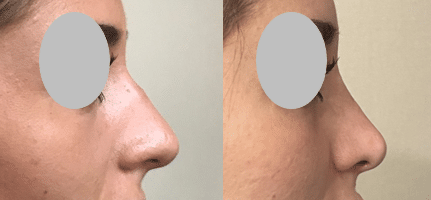 Rhinoplastie (janvier 2023)