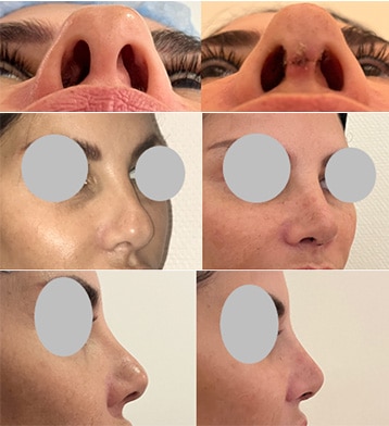 Rhinoplastie (janvier 2023)