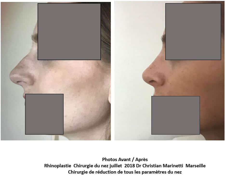 Rhinoplastie - Chirurgie de réduction de tous les paramètres du nez (juillet 2018)