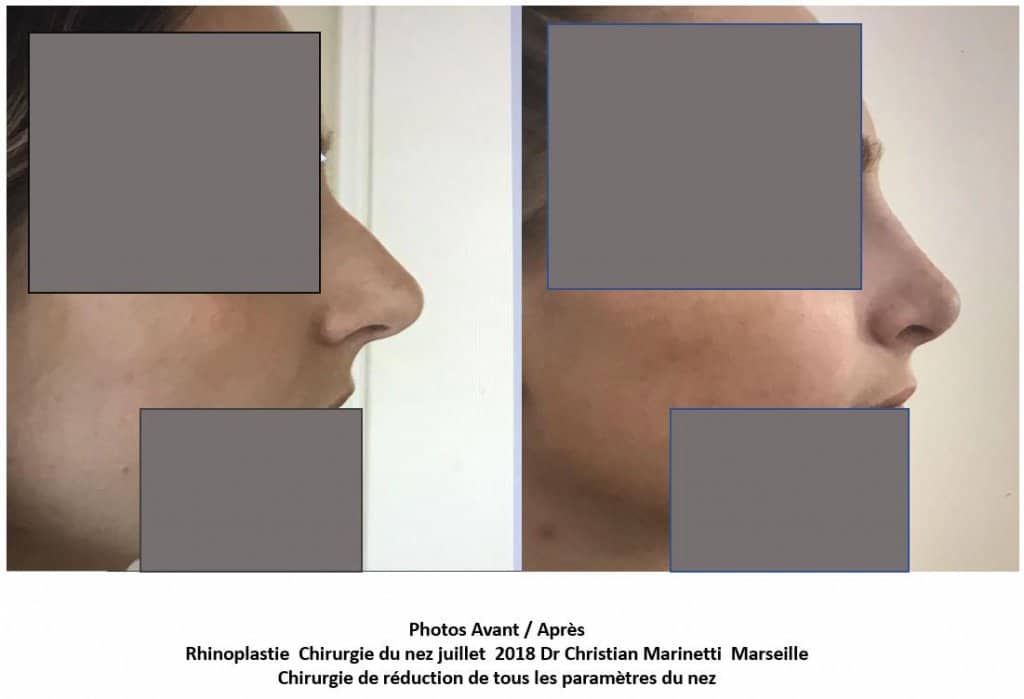 Rhinoplastie - Chirurgie de réduction de tous les paramètres du nez (juillet 2018)