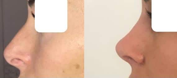 Rhinoplastie (mai 2021)