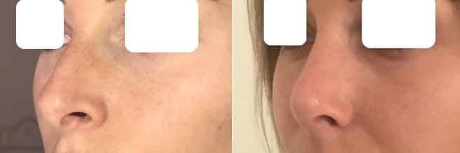 Rhinoplastie (mai 2021)