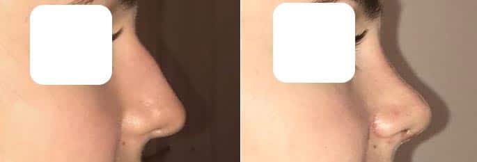 Rhinoplastie (mai 2021)