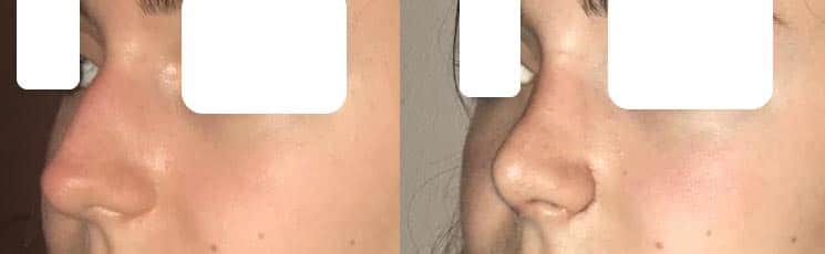 Rhinoplastie (mai 2021)