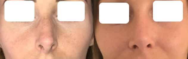 Rhinoplastie (mai 2021)