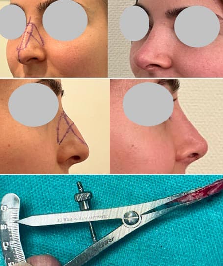 Rhinoplastie - Malformation avec gêne fonctionnelle