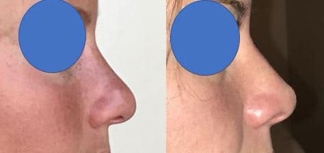 Rhinoplastie - Affinement et relèvement de la pointe du nez avec léger creusement de l'arête nasale par voie interne (mars 2021)