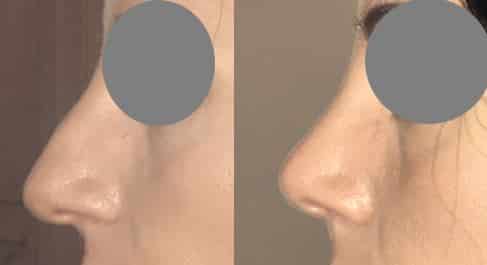 Rhinoplastie par voie fermée sans cicatrice externe - Résection de la bosse avec recul et remontée de la pointe nasale (mars 2021)