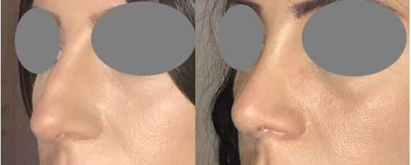 Rhinoplastie par voie fermée sans cicatrice externe - Résection de la bosse avec recul et remontée de la pointe nasale (mars 2021)