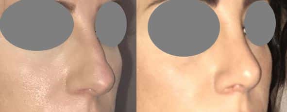 Rhinoplastie par voie fermée sans cicatrice externe - Résection de la bosse avec recul et remontée de la pointe nasale (mars 2021)