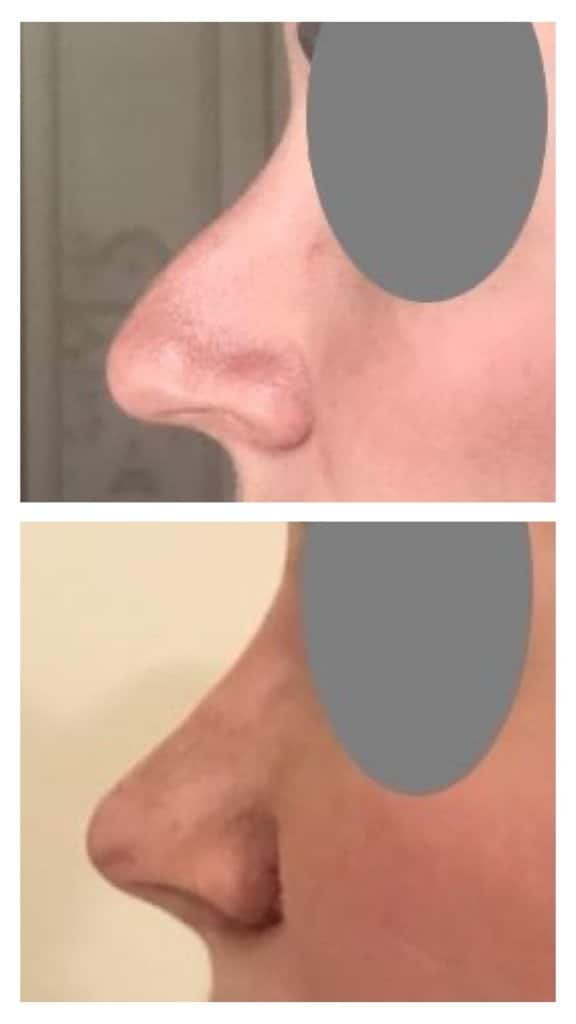 Rhinoplastie fermée pour réduction du nez - 10 jours à l'ablation du plâtre (mars 2021)