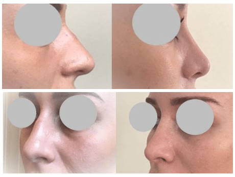 Rhinoplastie (mars 2022)