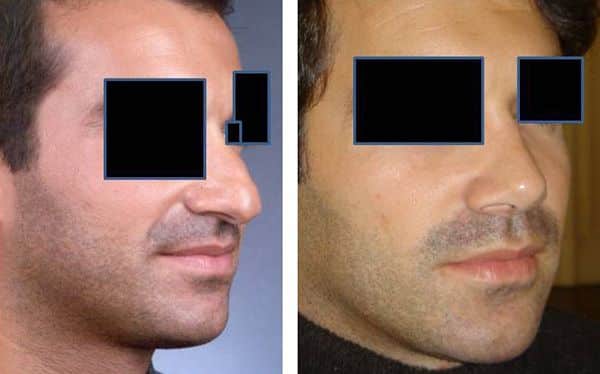 Rhinoplastie - Chirurgie du nez
