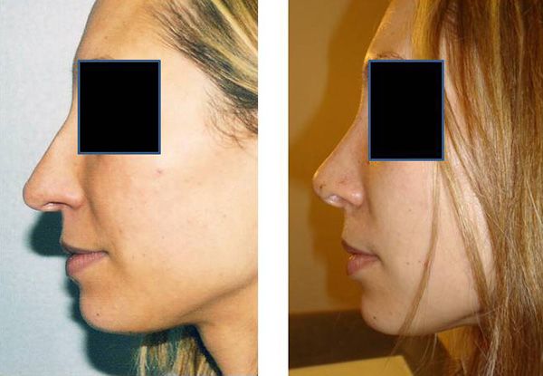 Rhinoplastie - Chirurgie du nez