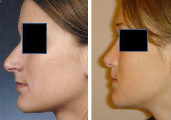 Rhinoplastie - Chirurgie du nez