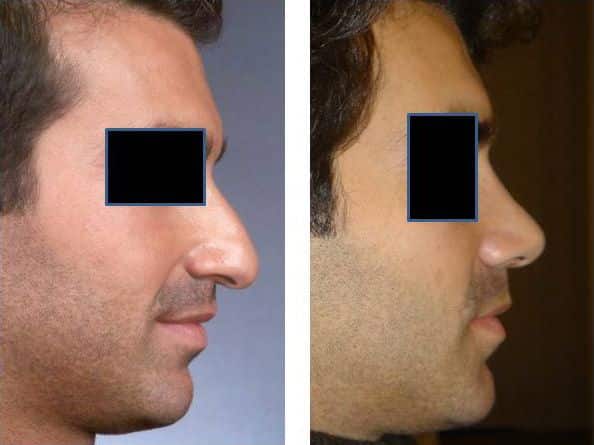 Rhinoplastie - Chirurgie du nez