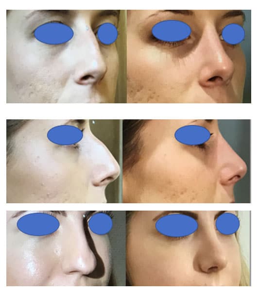 Rhinoplastie - Chirurgie du nez
