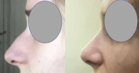 Rhinoplastie sans cicatrice externe - Recul, affinement et remontée de la pointe et suppression de la bosse (mars 2021)